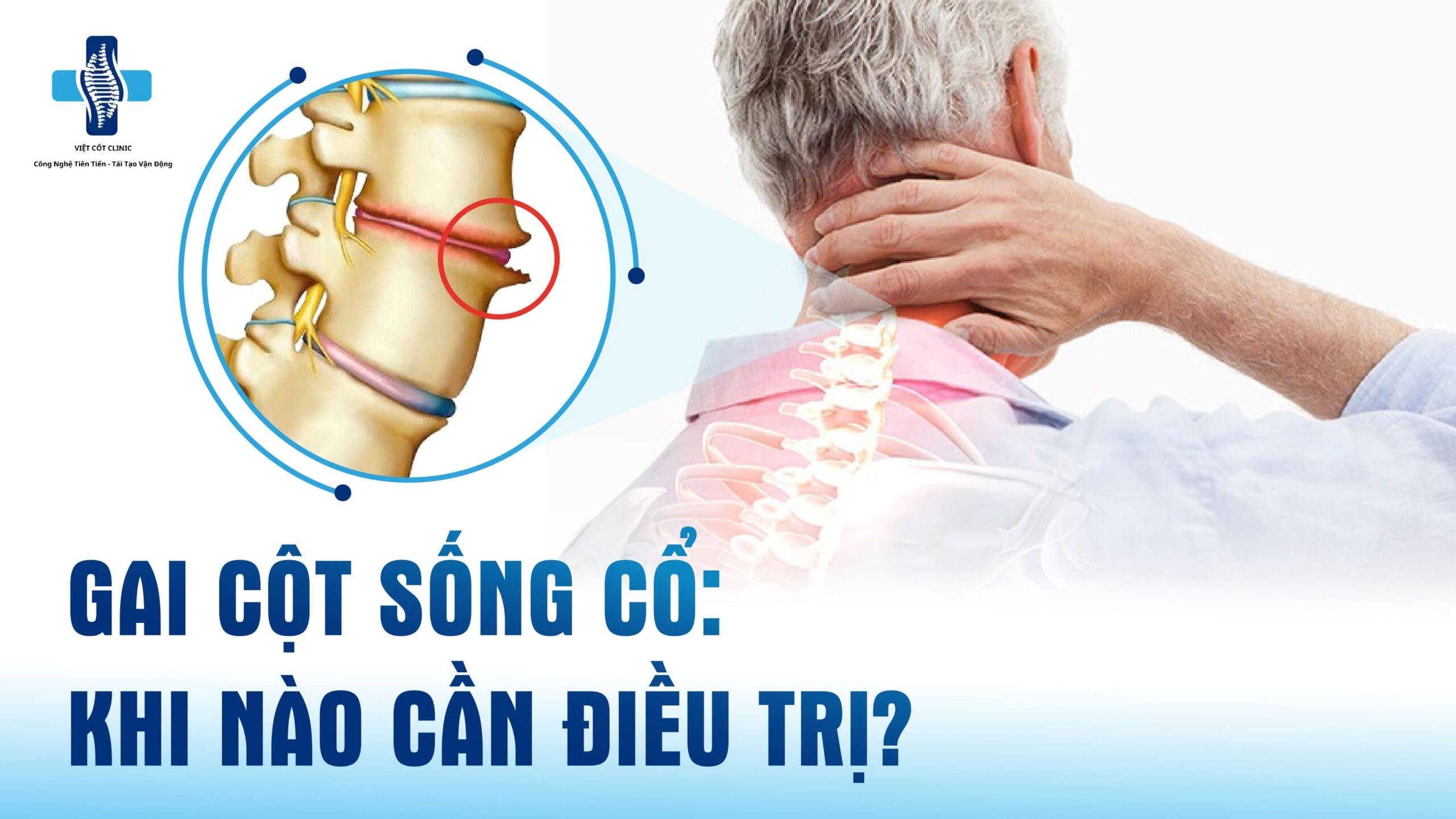 Gai cột sống cổ