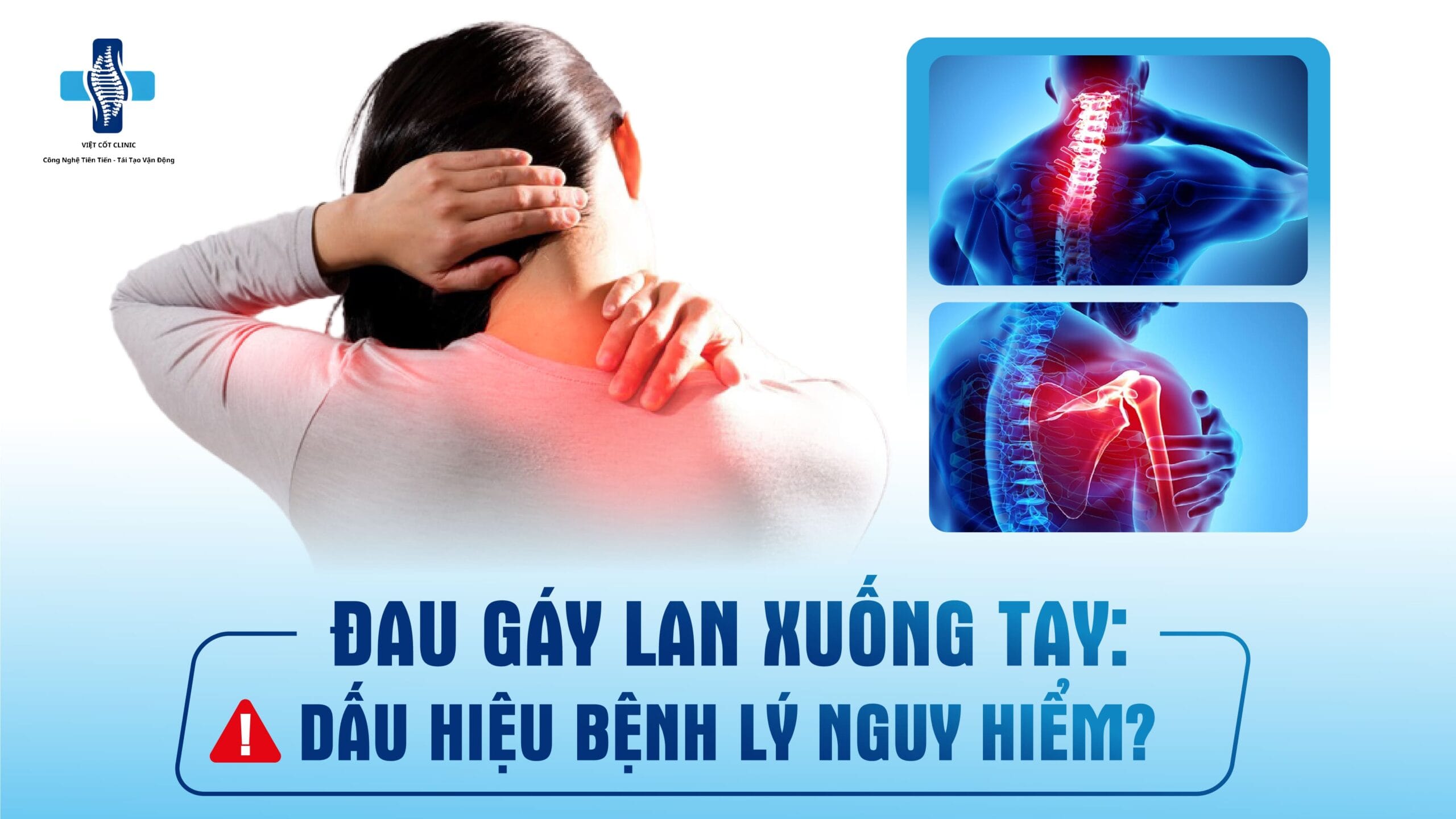 đau gáy lan xuống tay