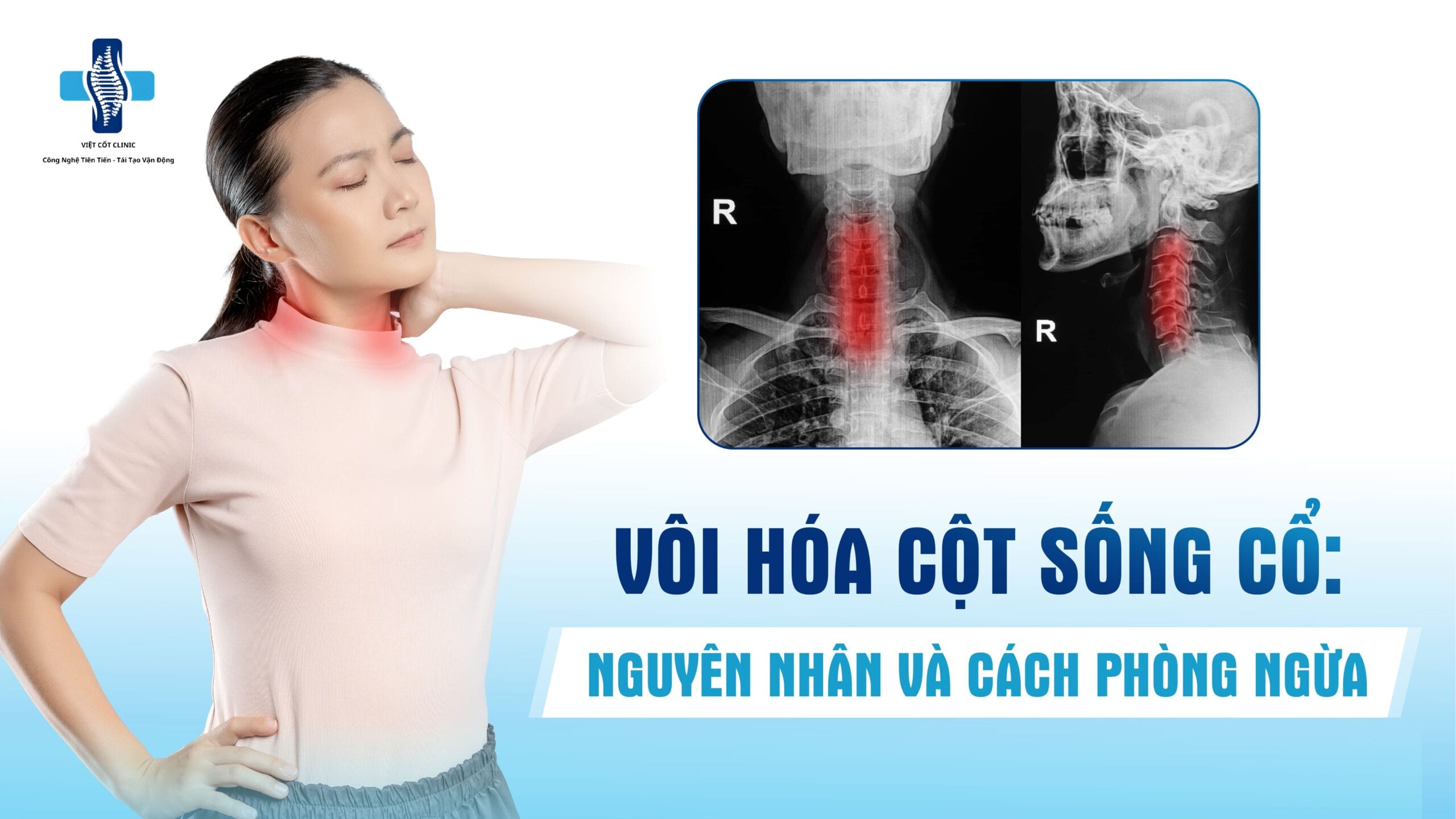 Vôi hóa cột sống cổ