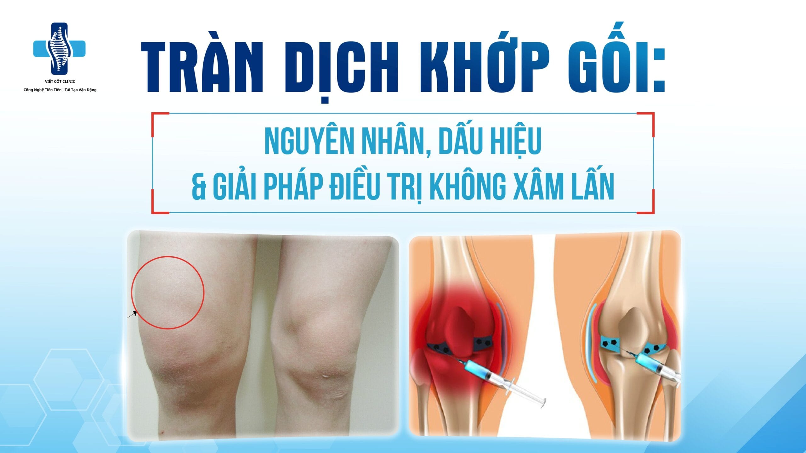 tràn dịch khớp gối